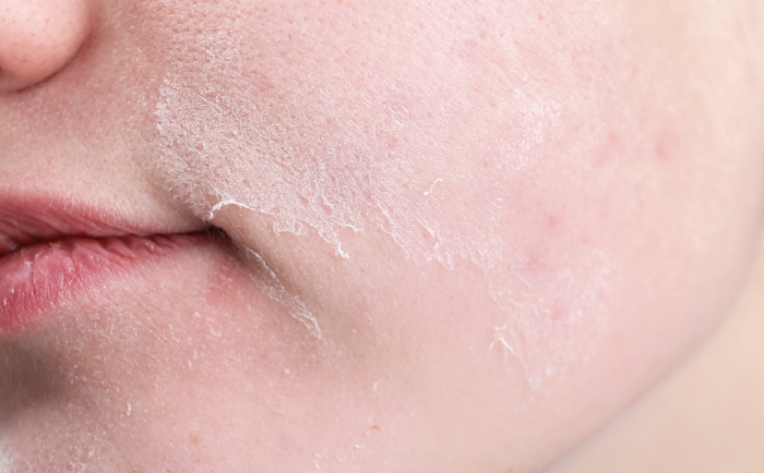 zrogowaciały naskórek